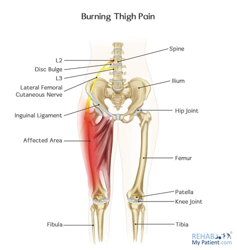 Burning Thigh Pain | Rehab My Patient