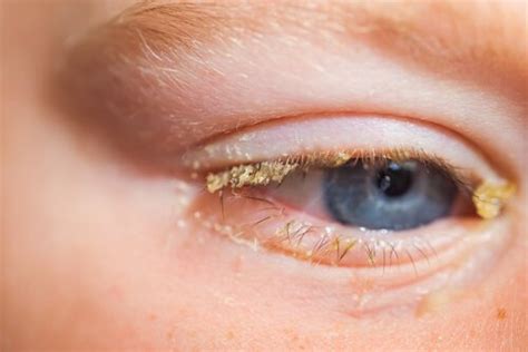 Conjunctivitis in Babies: Causes, Symptoms and Treatment - You are Mom