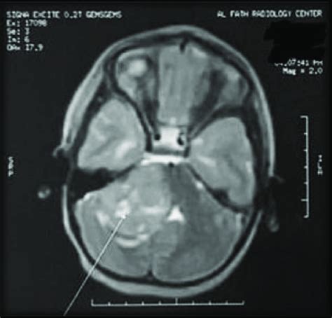 Preoperative MRI of a case showing a tumor originating from the pons... | Download Scientific ...