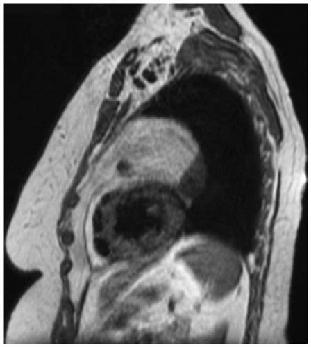 Teratoma | Thoracic Key