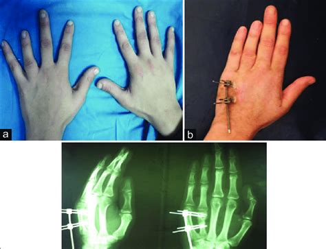 Left ring finger brachydactyly Type E 1. (a) Both hands, dorsal aspect ...