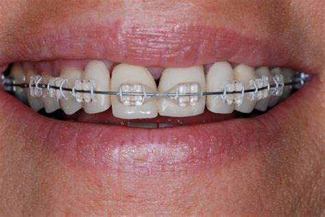 Perio / Prosthodontic / Orthodontic Rehabilitation | Rick Glassman, DDS, MAAFE