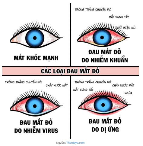 Cách điều trị đau mắt đỏ tại nhà nhanh khỏi không gây biến chứng