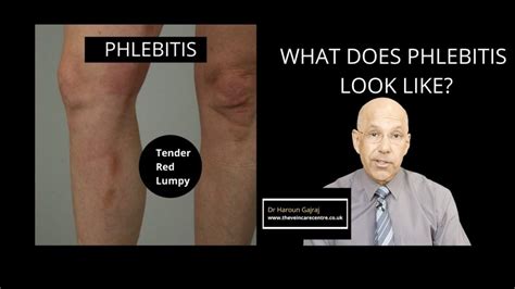 What Does Phlebitis of the Leg Look Like | with Pictures? | The VeinCare Centre