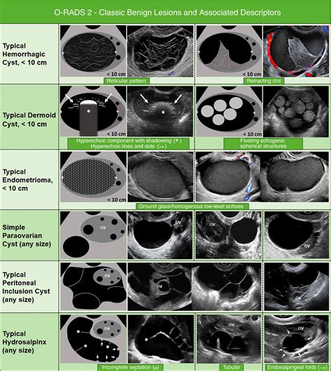 O-RADS Ultrasound Calculator - RadioGyan