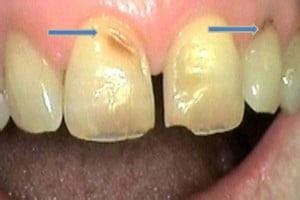 Tooth Wear Treatment Sidcup | Dentist Sidcup | Birkbeck Dentistry