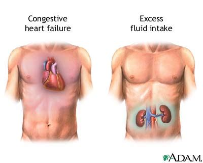 Congestive Heart Failure | Riverview Cardiac Surgery