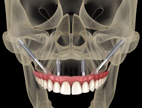 Zygomatic Implants Leeds | HQ Dental