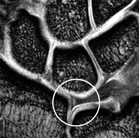 Tfcc Wrist Mri