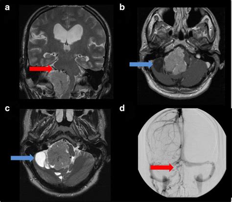 Coronal (A) and axial (B + C) MRI of type 3 choroid plexus papilloma:... | Download Scientific ...