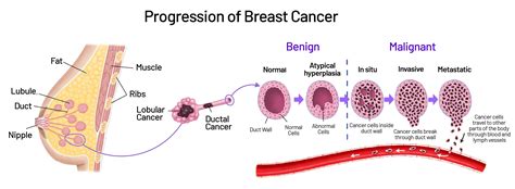 Types of Breast Cancer | Saint John’s Cancer Institute