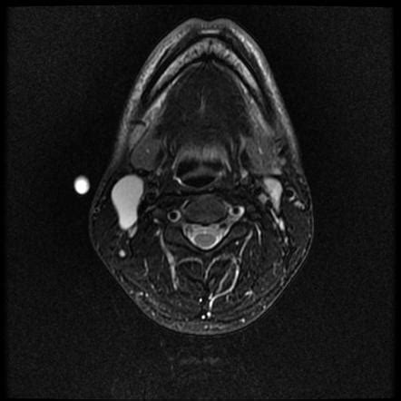 Branchial Cleft Cyst Ultrasound