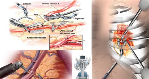 Robotic Cardiac Surgery