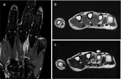 Recurrent synovial sarcoma in the dorsum of the hand: case 5. (a) MRI ...