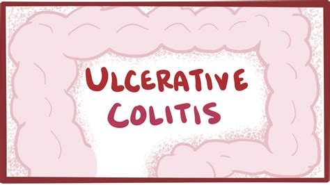 Ulcerative colitis natural cure Archives | Dr. Vikram Chauhan's Blog