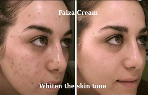 Faiza Cream – Features, Side effects, How to use? Is it harmful to skin?