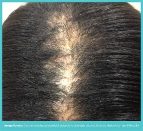 Central Centrifugal Cicatricial Alopecia: Causes & Treatment | Longevita