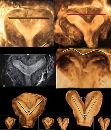 Partial Septate Uterus Ultrasound