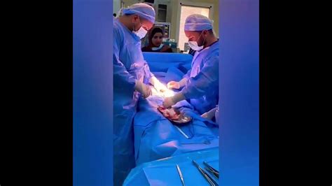 ovarian cystectomy procedure - YouTube