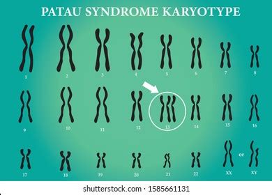 Karyotype Turner Syndrome Ts Known 45x 库存矢量图（免版税）1454594126 | Shutterstock