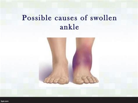 Possible causes of swollen ankle