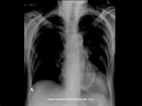 Heart Valve: Artificial Heart Valve X Ray