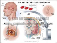 Neurosurgical Complications - S&A Medical Graphics