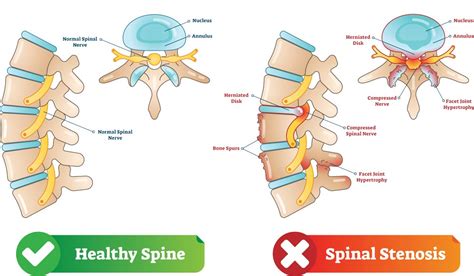 FORAMINAL STENOSIS - Texas Spine Care Center