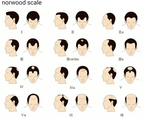 Types of Hair Loss in Toronto, ON by FREEDOMclinic