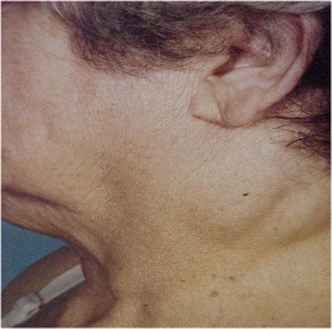 Optimal Imaging of Infiltrating Lipomas of the Neck - MedCrave online