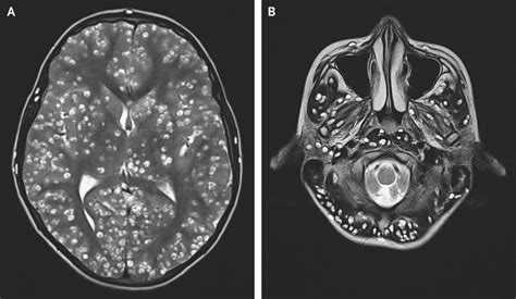 Indian doctors report rare case of Disseminated Cysticercosis