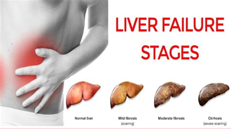 Stages Of Liver Disease