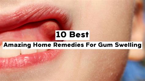 10 Best Amazing Home Remedies For Gum Swelling - YouTube