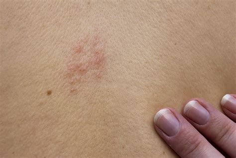 Shingles Pain Care Services in Salisbury and Rowan County Piedmont ...