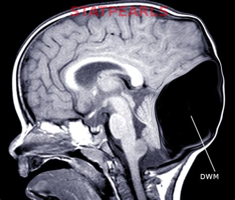 Dandy Walker Malformation - StatPearls - NCBI Bookshelf