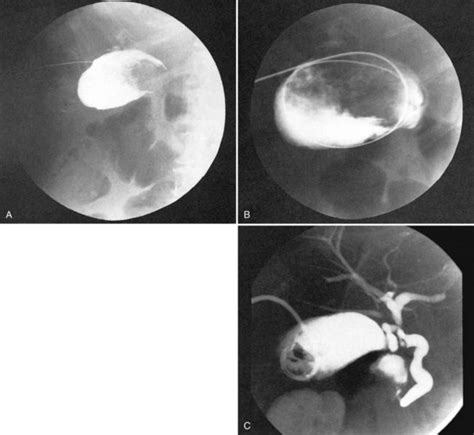 Percutaneous approaches to the treatment of gallbladder disease | Abdominal Key