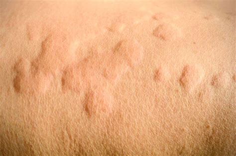 Urticaria: What Is Urticaria?