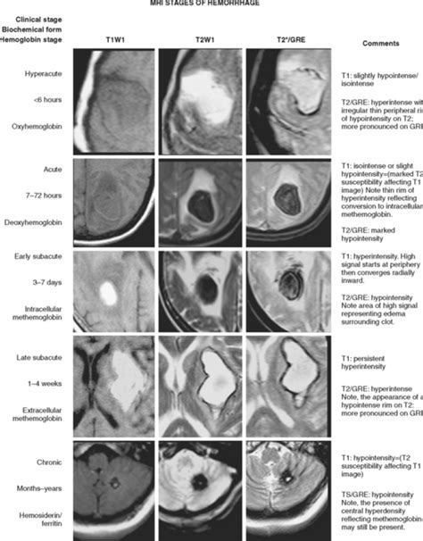 Spontaneous Intraparenchymal Hemorrhage | Radiology Key