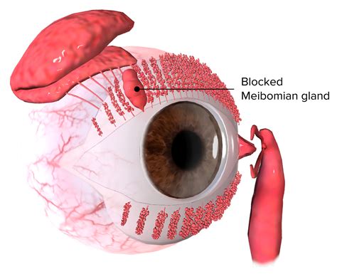 Chalazion (Clinical) | Concise Medical Knowledge