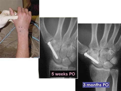 Arthroscopic Partial Wrist Fusion | Musculoskeletal Key