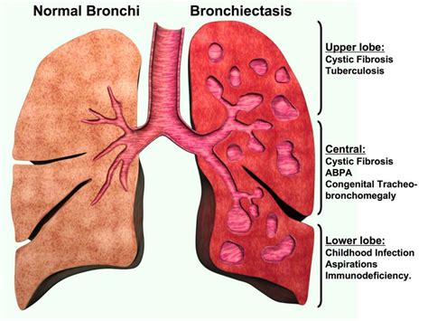 The Pathophysiology of Asthma: Mucus Plugging of the Airways