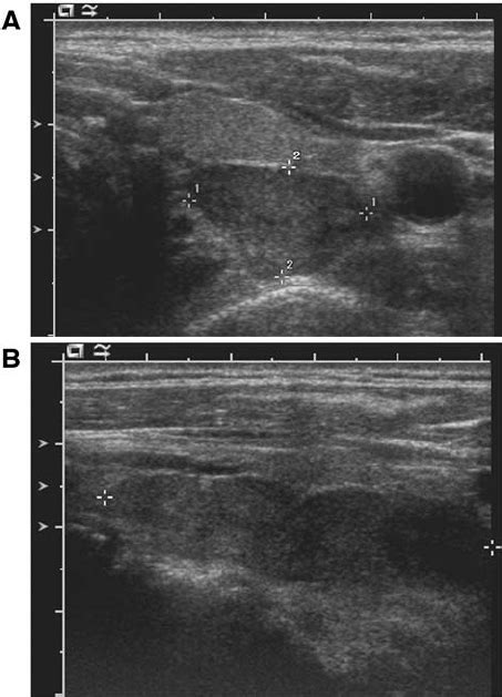 Ultrasound examination of the thyroid gland. Ultrasound of the thyroid ...