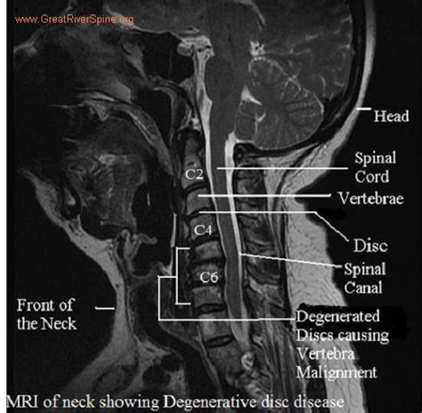 Cervical Disc Degeneration. Causes, symptoms, treatment Cervical Disc ...