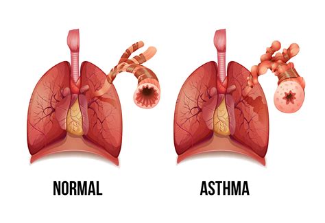 Top 6 benefits of cannabis for asthma - Sensi Seeds