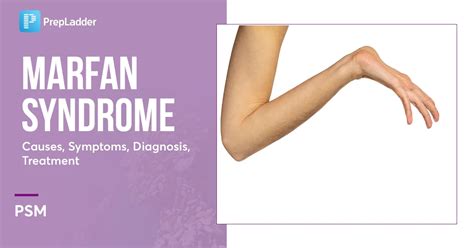 Marfan Syndrome Causes, Symptoms, Diagnosis, Treatment,, 58% OFF