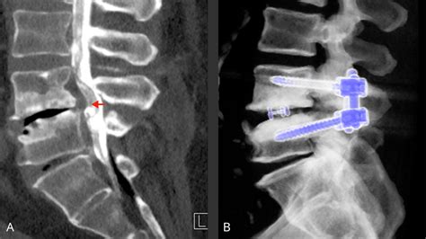 Spondylolisthésis | Neurochirurgie Inselspital Bern