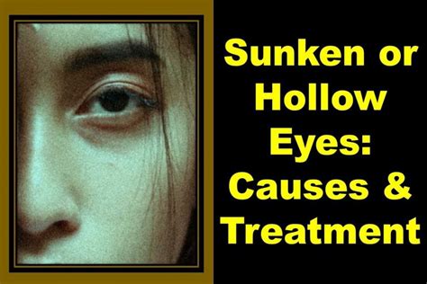 Sunken Eyes or Hollow Under Eyes: Causes, and Treatment | Health Kura