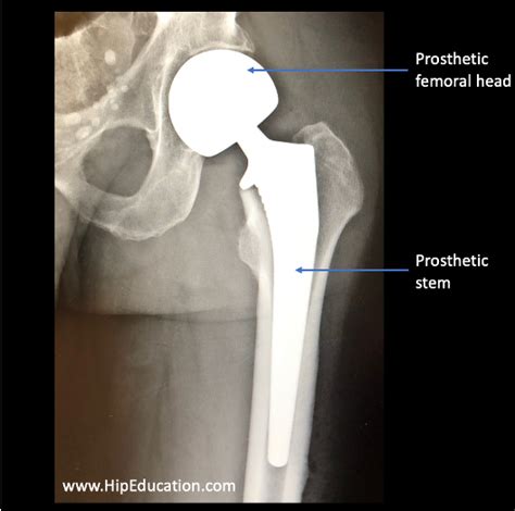 Hip Hemiarthroplasty - HipEducation