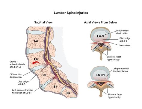 What You Need To Know About The L5 S1 (Lumbosacral Joint)