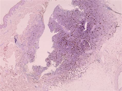 Dermatofibrosarcoma protuberans